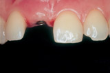 Implantat