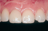 Implantat